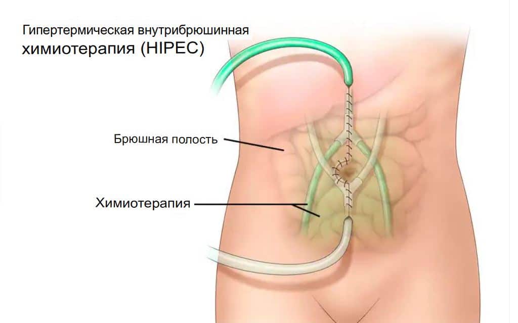 химиотерапия